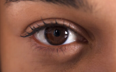 What Is Refractive Lens Exchange (RLE)?